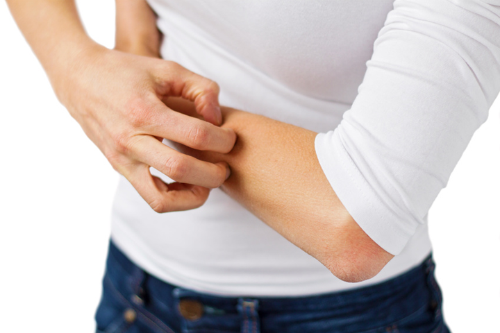 La dermatitis atópica ¿Qué es?