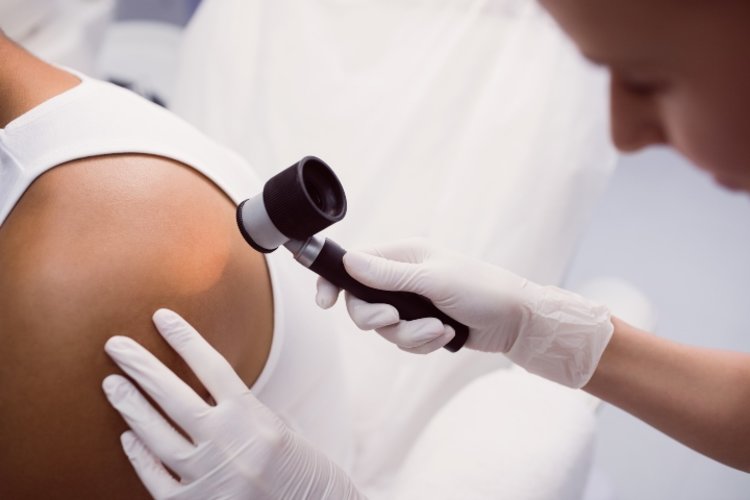 ¿Cómo ayudar a prevenir el cáncer de piel de tipo melanoma?