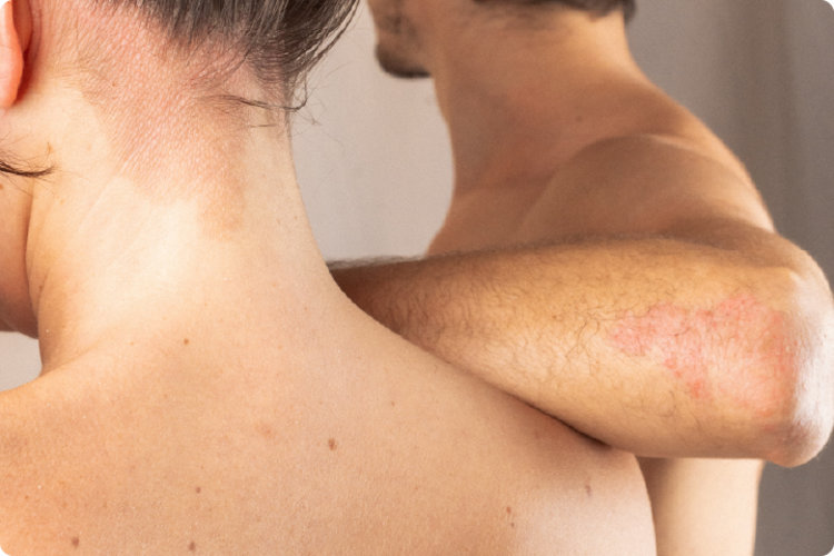 5 consejos para cuidar la piel con dermatitis atópica