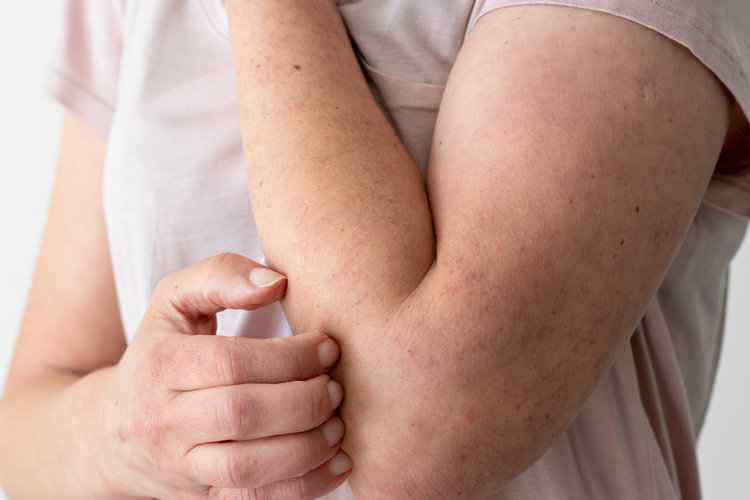 Dermatitis: qué es y cómo combatirla