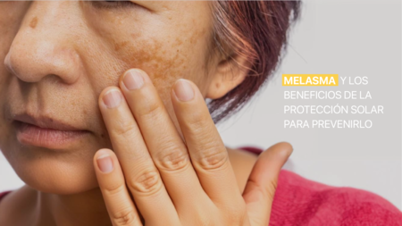 Melasma y los beneficios de la protección solar para prevenirlo